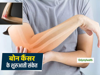 Bone Cancer Warning Signs: 10 से 30 साल के उम्र के बीच सबसे अधिक होता है बोन कैंसर, जानें इसके शुरुआती 7 संकेत 